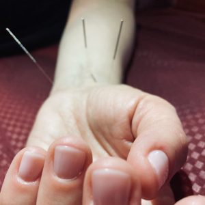 acupuncture treatment