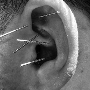 auricular acupuncture